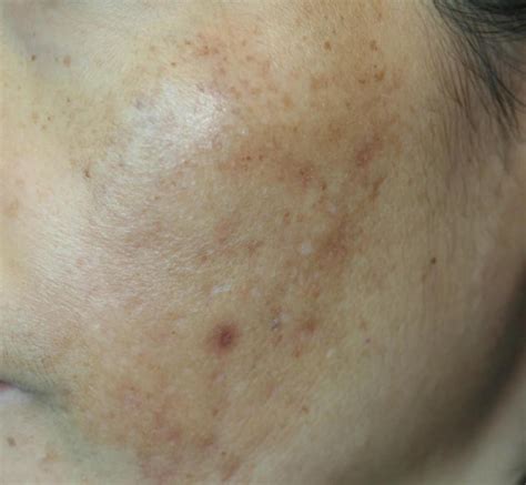 臉頰黑斑|黑斑 (Melasma)